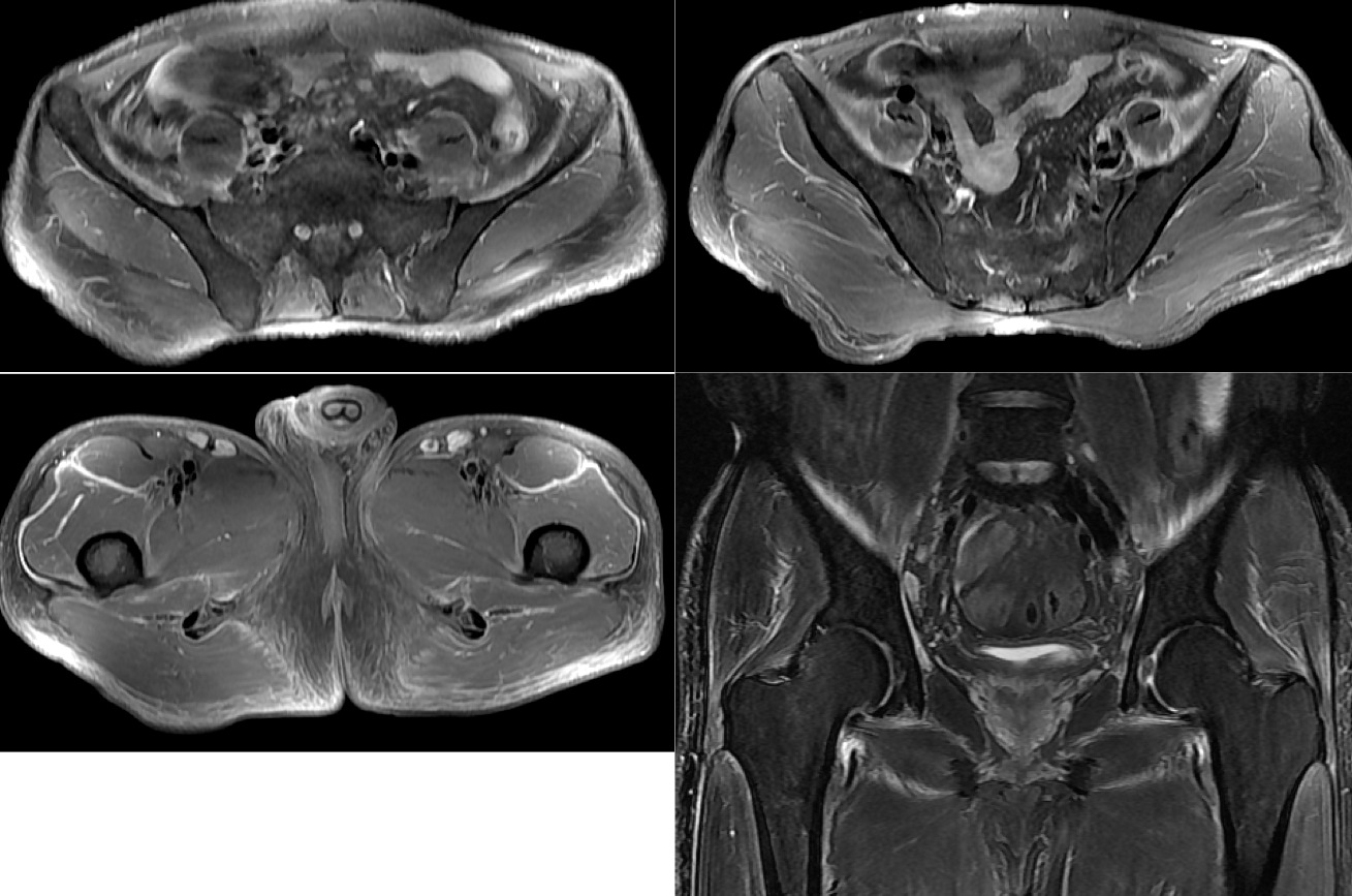 Figure 3 for case Systemic sclerosis with diffuse fascitiis